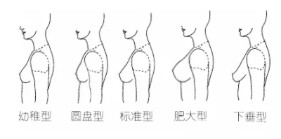 自体脂肪丰胸