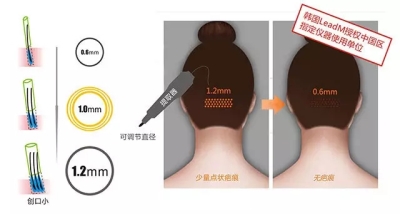 种植睫毛自身头发毛囊提取