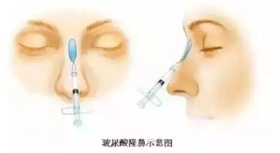 玻尿酸隆鼻原理图