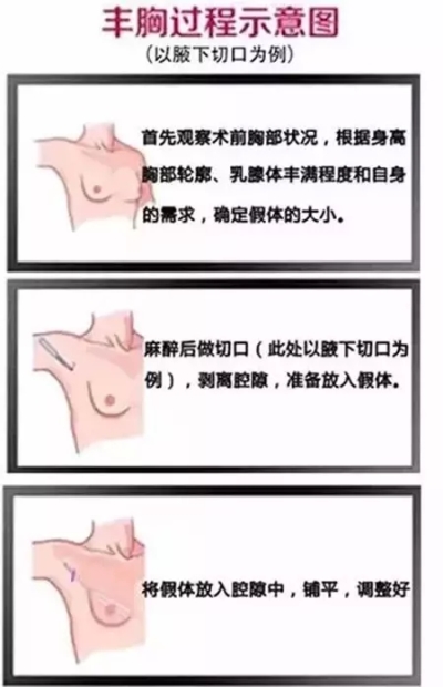 假体丰胸全过程