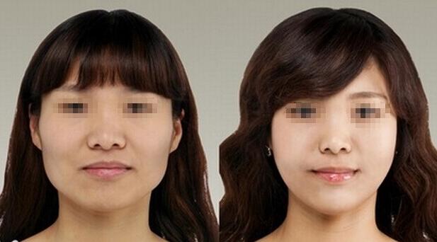 面部吸脂的禁忌症是什么