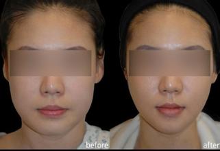 面部吸脂要多久之后才会有效