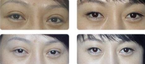 韩式三点双眼皮修复