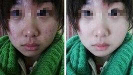 北京脸上的痘疤能用激光去除吗