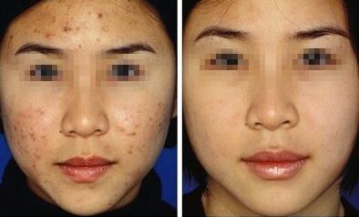 北京脸上的痘疤能用激光去除吗