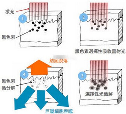 北京雀斑怎么治疗