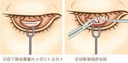 北京韩式祛眼袋有什么优势呢