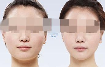 面部吸脂前后对比图