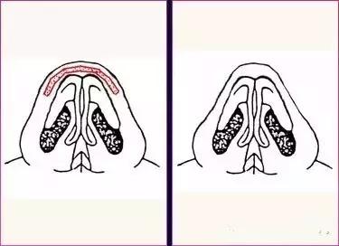 隆鼻的方法有哪些-哪个更适合自己