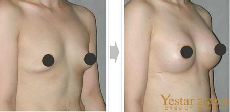 假体隆胸前后对比图