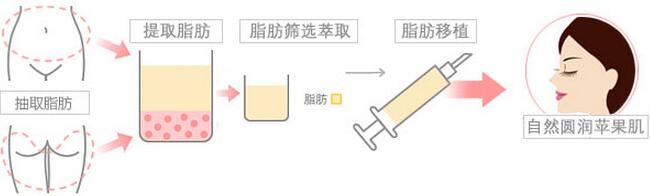 自体脂肪填充苹果肌的效果怎么样