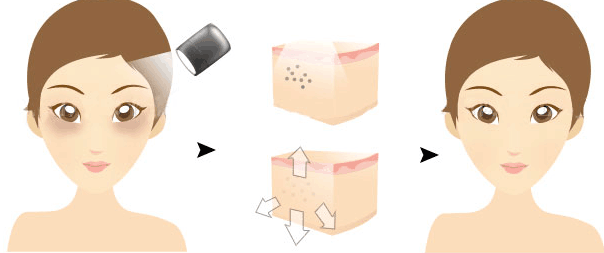 激光去黑眼圈