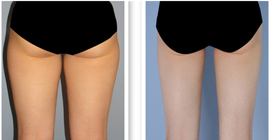 大腿吸脂前后对比图