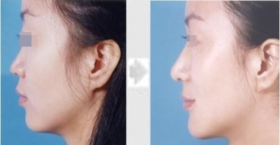 在北京做完假体隆鼻术后可以洗脸不