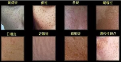 【北京艺星】色斑是如何形成的？你对色斑的了解有多少