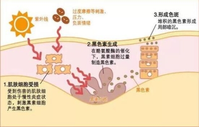 【北京艺星】色斑是如何形成的？你对色斑的了解有多少