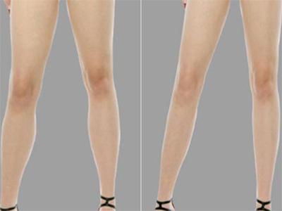 小腿吸脂：美丽双腿变修长美腿