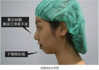 北京艺星做双眼皮+隆鼻+垫下巴前后对比效果