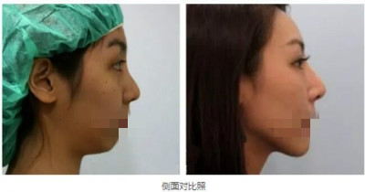 北京艺星做双眼皮+隆鼻+垫下巴前后对比效果