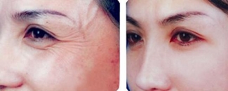 如何去除皱纹?戳进来你就知道了